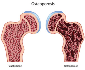 OsteoporosisDiagramW